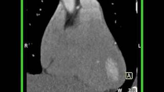 Cardiac 3D and 4D mapping of a coronary CTA 1 of 6 [upl. by Storfer]