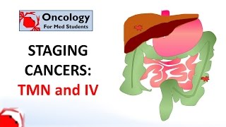 Staging cancers TNM and IIV systems [upl. by Lertram]