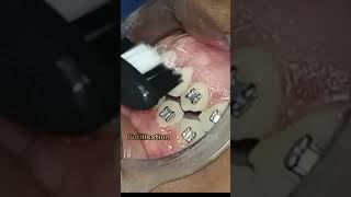 Technique de brossage des dents électrique avec brackets [upl. by Waneta124]