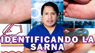 CÓMO SE DIAGNOSTICA LA SARNA  DR APARI [upl. by Rodman]