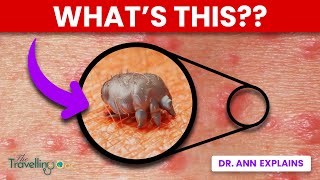 Scabies  WARNING Doctor explains Causes Symptoms and Treatments [upl. by Assilak]