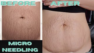 I Got Professional Microneedling Done on my Stretch Marks Results and What to Expect [upl. by Currie]