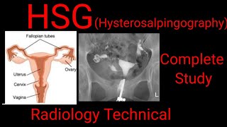 HSG  Hysterosalpingography Complete study Radiology technical  by BL Kumawat [upl. by Furtek]