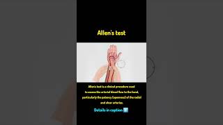 Allen test mbbs emergencymedicine doctor [upl. by Zashin]