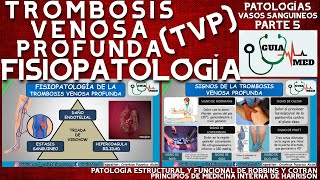 TROMBOSIS VENOSA PROFUNDA FISIOPATOLOGÍA  GuiaMed [upl. by Paddy]