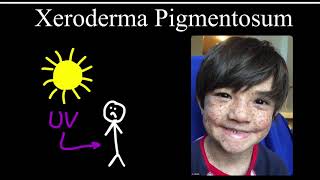 Xeroderma Pigmentosum [upl. by Jabez]