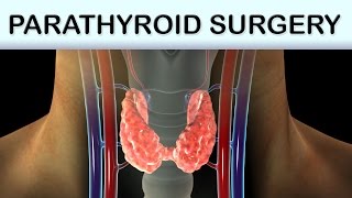 Parathyroid Surgery Medical Animation [upl. by Vanny]