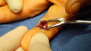 Live Surgery Foreign Body BB Removal from Finger [upl. by Nawyt]