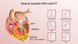 Advanced EKGs  Ventricular Tachycardia Classification amp Localization [upl. by Pain440]