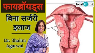 बच्चेदानी में फॉयब्रॉयड या रसौली का इलाज । Fibroid in Uterus  symptoms and treatment [upl. by Vullo]