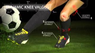 Anterior Cruciate Ligament ACL Injury [upl. by Anoek673]