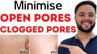 Open PoresClogged Pores amp Enlarged Pores Solution with Home Remedies [upl. by Aikit56]