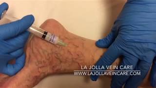 Vein Visionaries Highlighting the Best Sclerotherapy Videos of 2024 [upl. by Efar353]