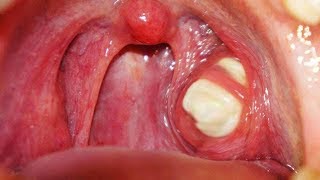 Home Remedies For Sore Throat [upl. by Nodmac]