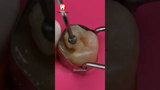 Root Canal Treatment shorts [upl. by Burget]