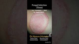 Fungal Infection Tinea For Treatment at Kotla clinic 03331045021  Barnala clinic 03116268227 [upl. by Ahsias]