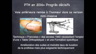 Prothèse Totale de Hanche PTH en 2016 [upl. by Tiffie116]