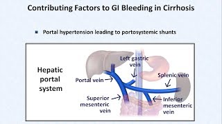 Esophageal Varices and Variceal Hemorrhage [upl. by Jamel1]