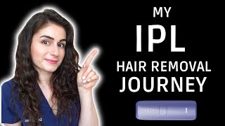 My IPL hair removal journey  Ulike IPL at home [upl. by Saltsman]