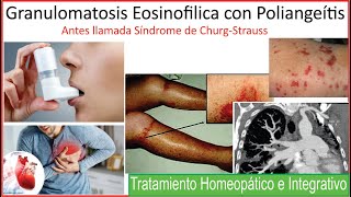 Granulomatosis Eosinofilica con poliangeitis Tratamiento homeopatico e integrativo [upl. by Depoliti]