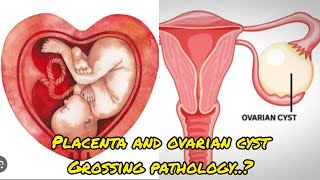 Placenta with umbilical cord and uterus with ovarian cyst specimen grossing😨placenta ovariancyst [upl. by Trish]