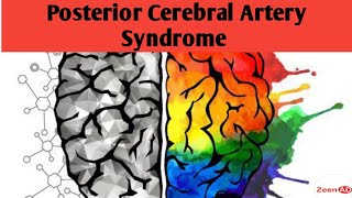 Posterior Cerebral Artery SyndromePosterior Cerebral Artery StrokePart 2Vascular Strokes [upl. by Drus546]