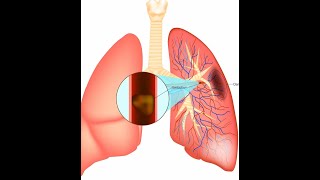 Pulmonary Embolism [upl. by Marin77]