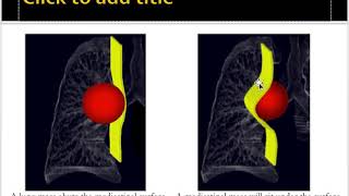 Mediastinal masses approach [upl. by Kred]