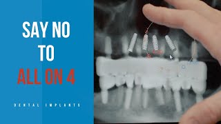 SAY NO to All on 4 I Exploring the Difference Between Allon4 and Allon6 Dental Implants [upl. by Welton368]