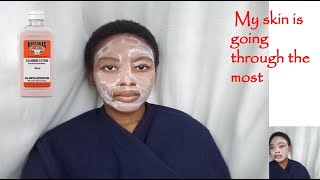 Using Calamine lotion  Caticura and Aqueous cream for clear skin [upl. by Ayaet487]