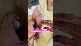 Cannulation technique nurses cannula shorts doctor neet mbbs bscnursing subscribe ytshorts [upl. by Ajnot]