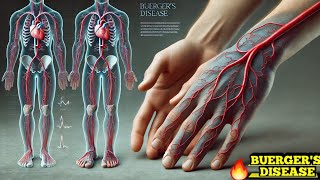 Buergers Disease Thromboangiitis Obliterans Easy Explanation [upl. by Aspia793]