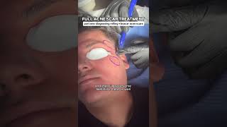 Full Acne Scar Treatment with Dr Qazi  Part one diagnosing rolling  boxcar scars acnescars [upl. by Yadahs]