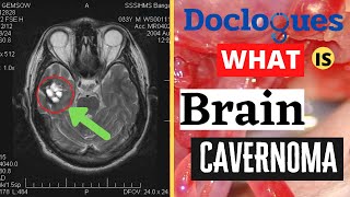 What Is Brain Cavernoma [upl. by Grantley]