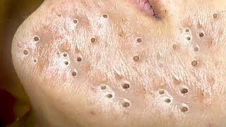 Big Cystic Acne Blackheads Extraction Blackheads amp Milia Whiteheads Removal Pimple Popping  8387 [upl. by Fidelia939]