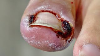 JUICY INFECTED INGROWN TOENAIL Youre Welcome [upl. by Ahsikam]