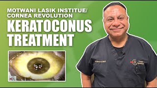 Keratoconus Surgery Laser Treatment [upl. by Eirene]