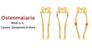 What is osteomalacia [upl. by Seugram]