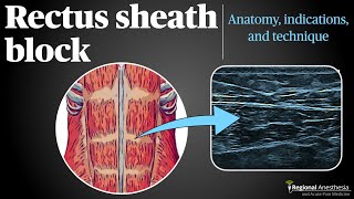 Rectus Sheath Block [upl. by Aneleasor]