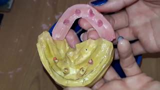 Rodete de cera sobre implantes dentales [upl. by Elehcim]