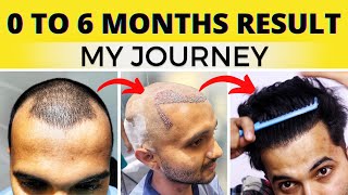 My Full Hair Transplant Journey From Day 1 To 6 Months  Best Hair Transplant Result In India 2022 [upl. by Reave]