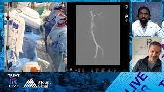 Transradial Genicular Artery Embolization GAE for Knee Osteoarthritis OA [upl. by Leahcimed]