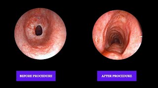 Post Tracheal reconstruction surgery Tracheal stenosis  Bronchoscopic Repair [upl. by Melise]