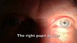 Relative afferent pupillary defect RAPD [upl. by Merrily]