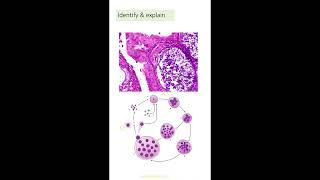 Shorts Exam slides Giant cells 2Dr GSS SRM MCH RC [upl. by Ridgley378]