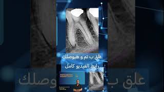 Clinical cases in Endodontics الكربولة endodontics dental [upl. by Llevad]