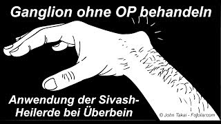 Behandlung von Ganglion Überbein am Handgelenk ohne OP  kurzes Anwendungsvideo [upl. by Valsimot]