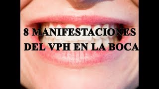 8 manifestaciones de VPH en la boca [upl. by Leelaj]