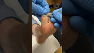 Expert Big Toe Callus Removal by Podiatrist in Australia  Ergonx amp Docpods Treatment [upl. by Niamert864]