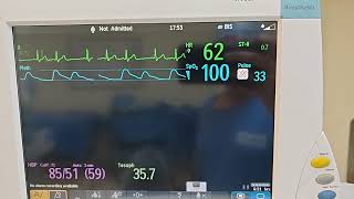 supraventricular trigeminy [upl. by Colwen747]